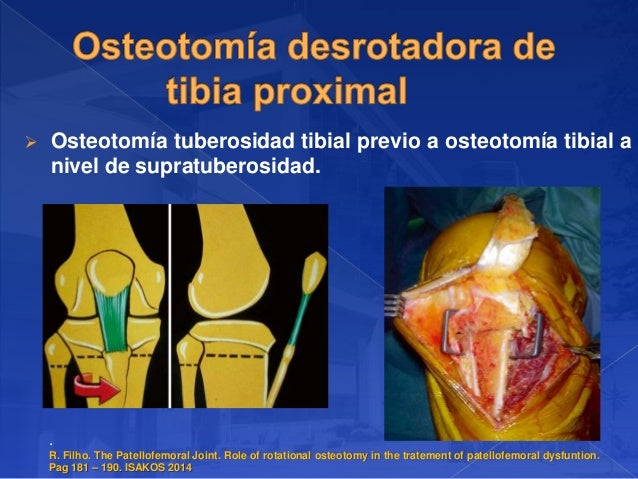 anteversion femoral torsion tibial externa en tac pdf