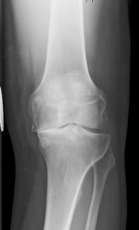 artrosis de rodilla que es pdf