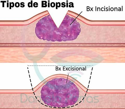biopsia incisional y excisional pdf
