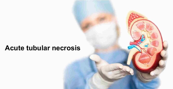 causas de necrosis tubular aguda pdf